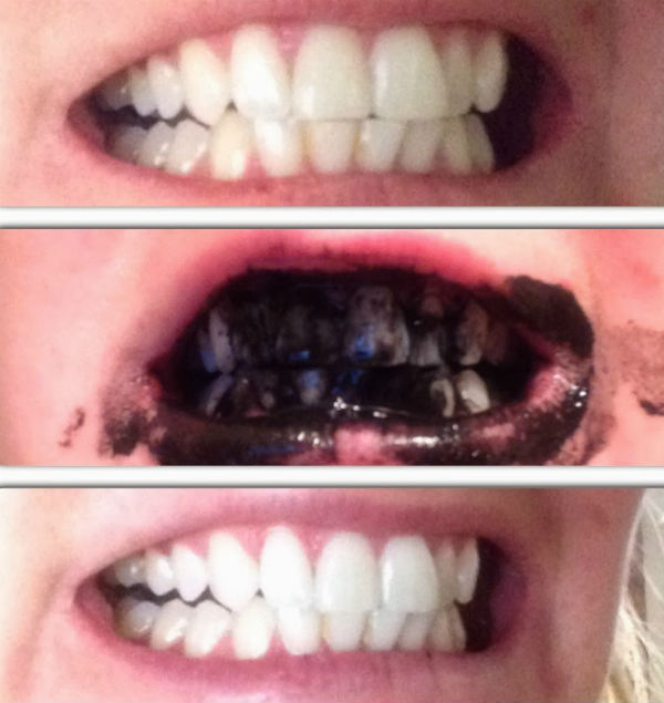 Отбеливание зубов активированным углем: фото до и после