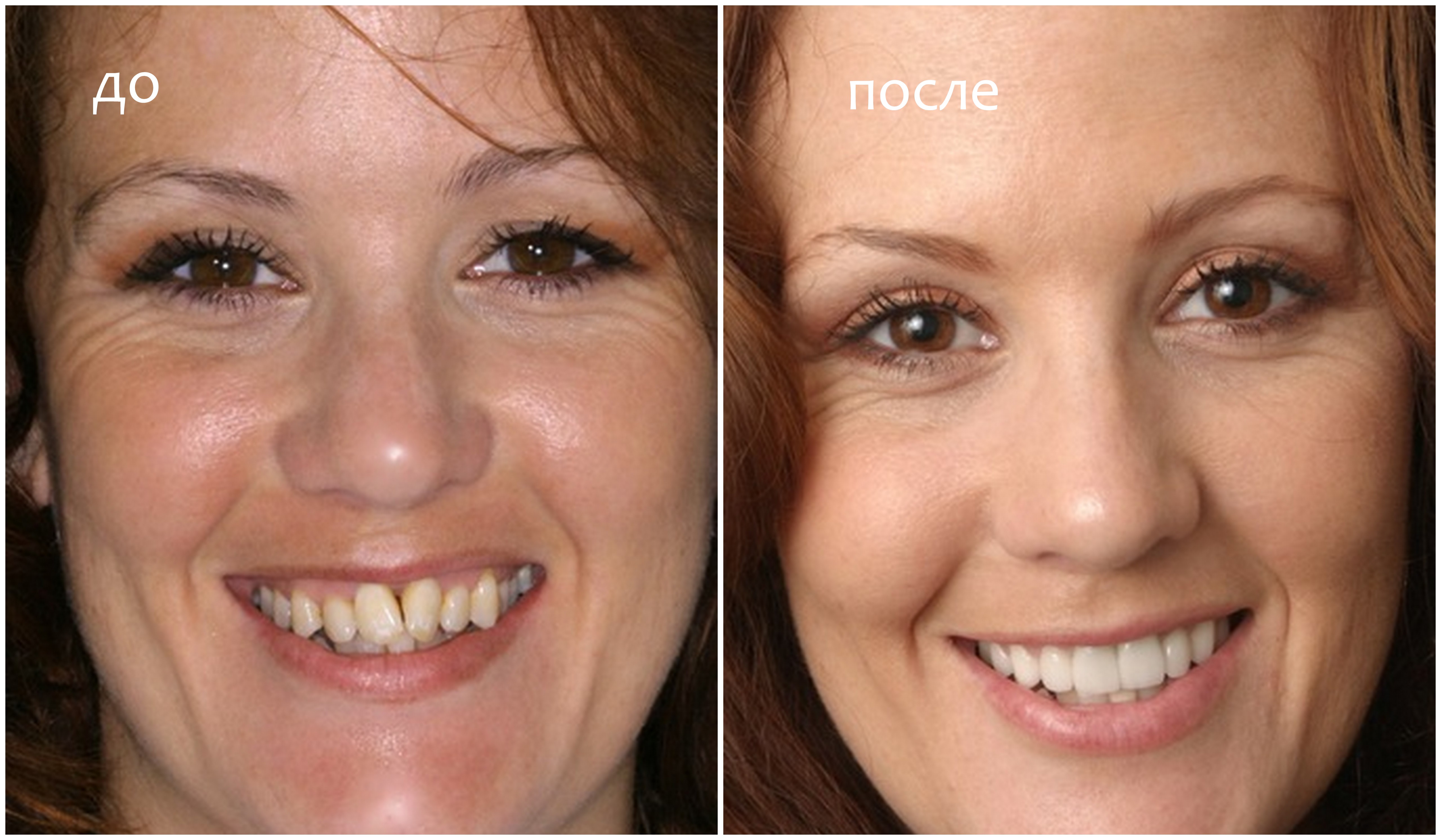 Исправление кривых зубов винирами фото до и после