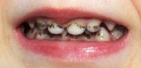 О чем говорит черный налет на зубах у ребенка?