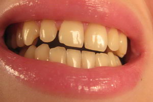 Чим тонша зубна емаль, тим жовтішим стає зуб.
