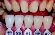 Optimum shade of teeth corresponds to…