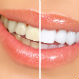 What do you know about safe teeth whitening?